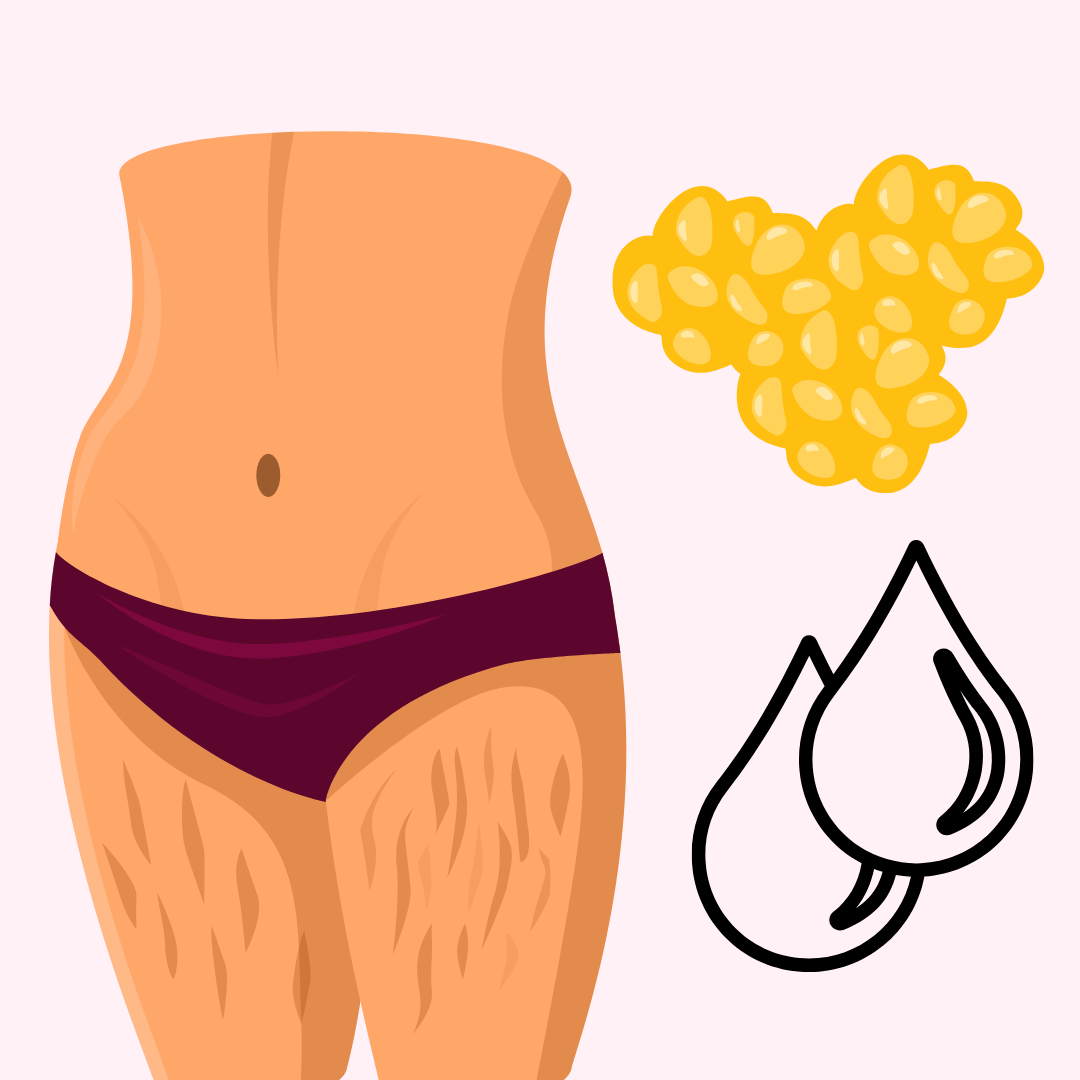Behandlung Lipödem Cellulite Wassereinlagerungen - Biberach